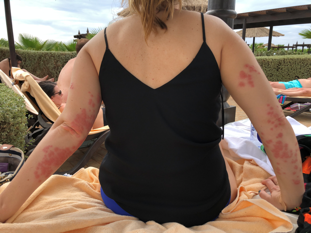 Tui customer furious after she’s left with infected arms from bed bugs on £3k luxury holiday – and then IGNORED by tour operator